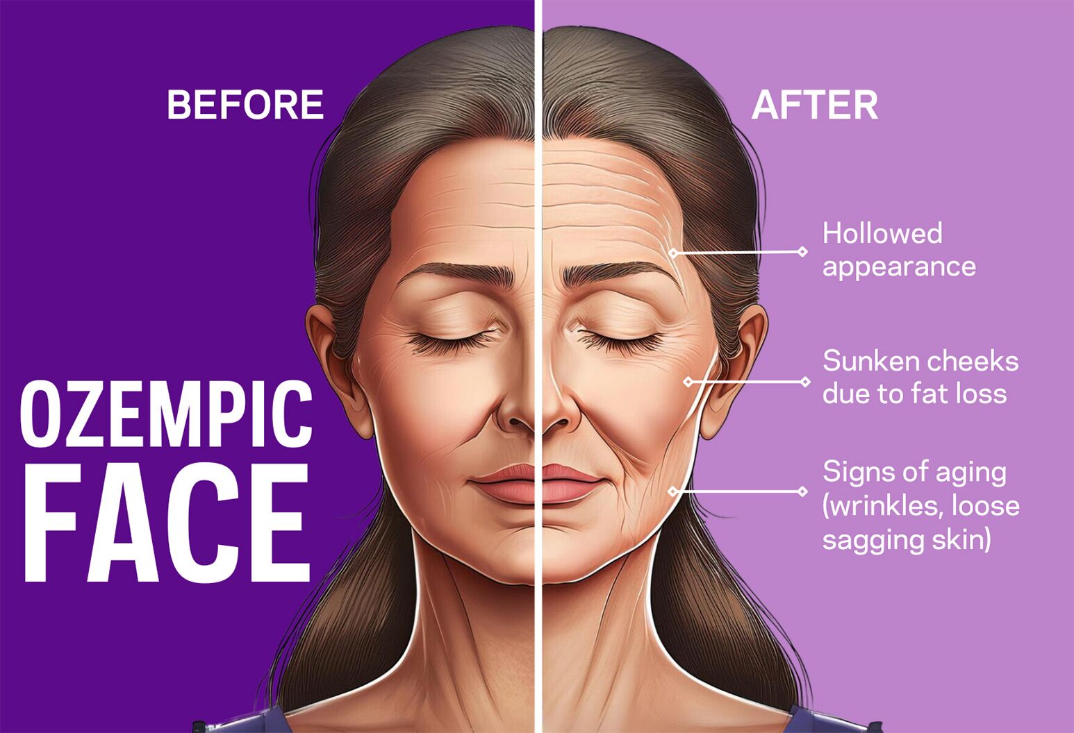 ozempic face